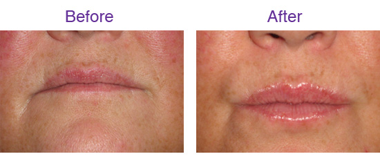 Before and After Juv�derm� Ultra Smile Treatment
