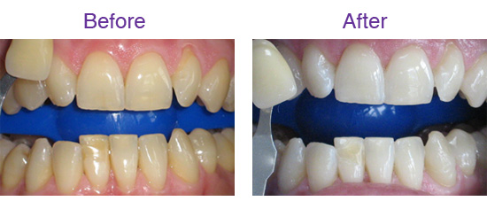 Before and After Tooth Whitening Treatment